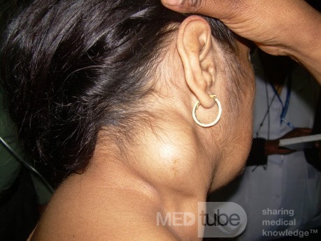 Large Lipoma Of The Neck