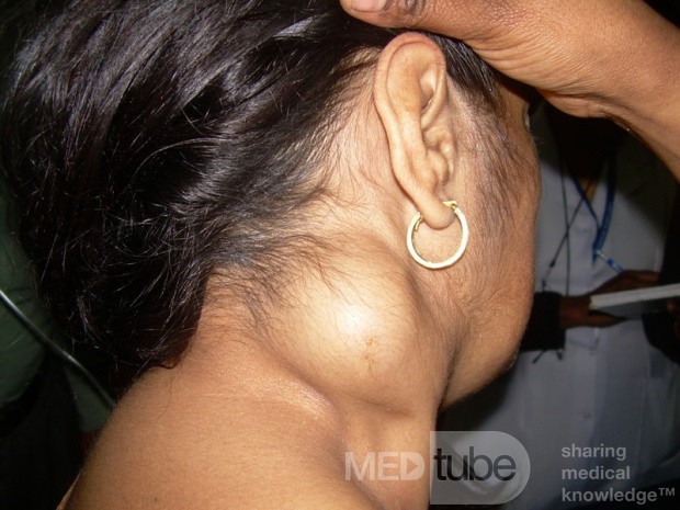 Large Lipoma Of The Neck • Picture • MEDtube.net