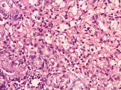 Gastric Cancer (14 of 15)