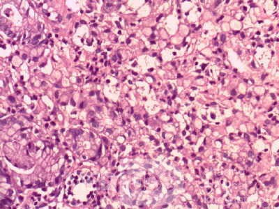 Gastric Cancer (14 of 15)