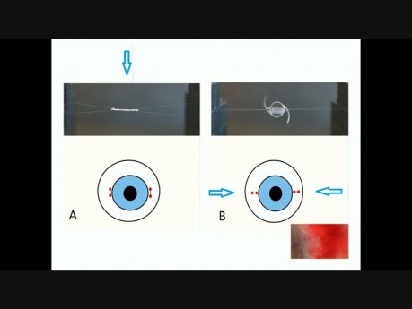 Crystalline Lens Luxation to the Anterior Chamber and Modified Scleral Suture Fixation