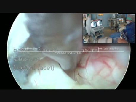 Interlaminar Endoscopic Lumbar Disc Herniation and S1 Spur Decompression