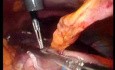 Gastrointestinal Stromal Tumor - GIST (43 of 65)