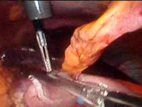 Gastrointestinal Stromal Tumor - GIST (43 of 65)