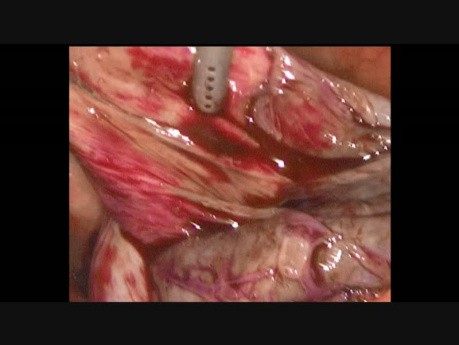 Ovarian Endometrioma Huge Cyst Removal