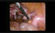 Total Laparoscopic Hysterectomy