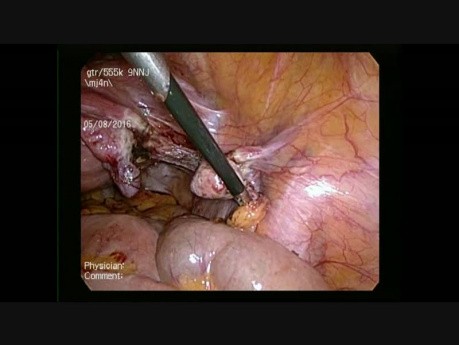 Total Laparoscopic Hysterectomy