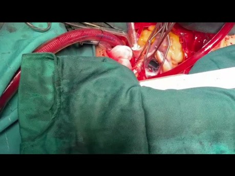Modified MVR in Patient with Small LA 