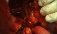 Splenectomy video