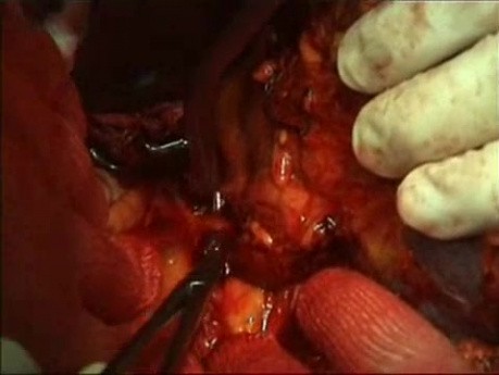 Splenectomy video