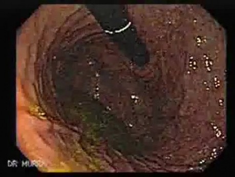 Esophageal Achalasia - Impaction of foreign bodies (piece of meat) (3 of 5)