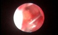 Semi-Rigid Ureteroscopy - Stone Removal