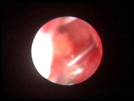 Semi-Rigid Ureteroscopy - Stone Removal