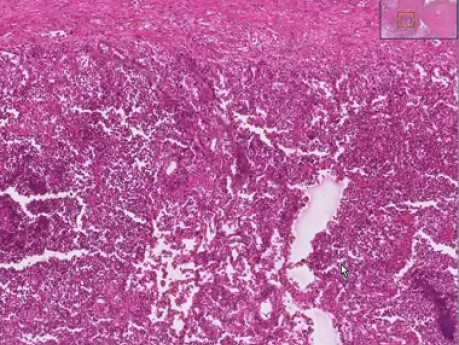 Bronchopneumonia