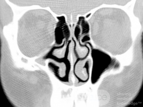 Maxillary Sinus Hypoplasia  [Type 3]