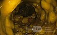 Endoscopic appearance of the Pseudomembranous colitis