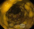 Endoscopic appearance of the Pseudomembranous colitis