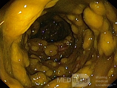 Endoscopic appearance of the Pseudomembranous colitis