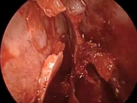 Two Caused of Nasal Obstruction and Methods of Treatment