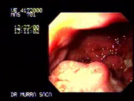 Gastric Adenocarcinoma - Gastroscopy