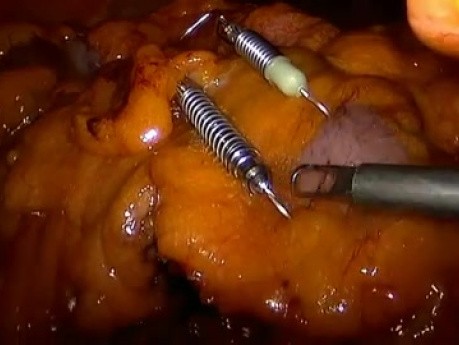 Laparoscopic Right Colectomy Reduced Ports with Transvaginal Specimen Removal