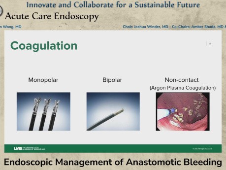 Endoscopic Management of Anastomotic Bleeding