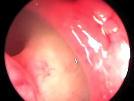 Balloon Dilation of Ostium under Local Anesthesia