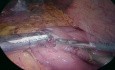 Gastric Bypass Reversal to Sleeve Gastrectomy for Hypoglycemia