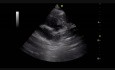 Sub Aortic VSD (2)