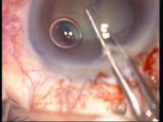 Phacoemulsification - Complications