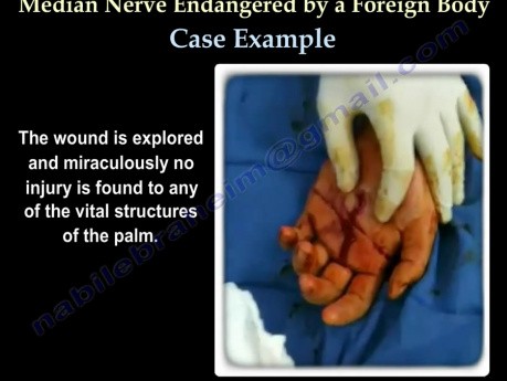 Median nerve endangered by a foreign body 