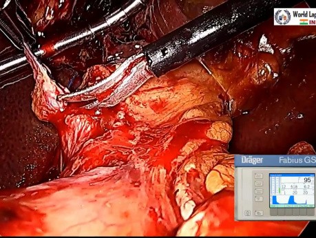 Laparoscopic Repair of Common bile duct (CBD) injury