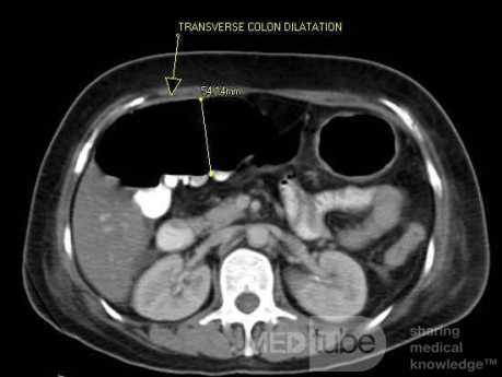 Multiple Rectal Ulcers (43 of 110)