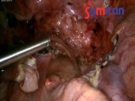 Uterine Size 24 to 26 wks Big Mass 3D Difficult TLH