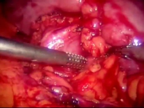 Laparoscopic Partial Kidney Excision Due To Renal Tumor In Solitary Kidney Case