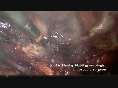 Hemi Hysterectomy for Pseudo Unicornuate Uterus