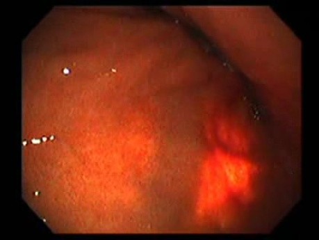 Gastrointestinal Stromal Tumor - GIST (15 of 65)