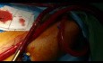 Unicaval Heart Transplantation in Patient with Prolonged ECMO 