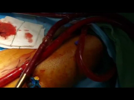 Unicaval Heart Transplantation in Patient with Prolonged ECMO 
