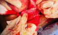 Abdominal Myomectomy