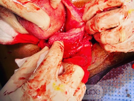Abdominal Myomectomy