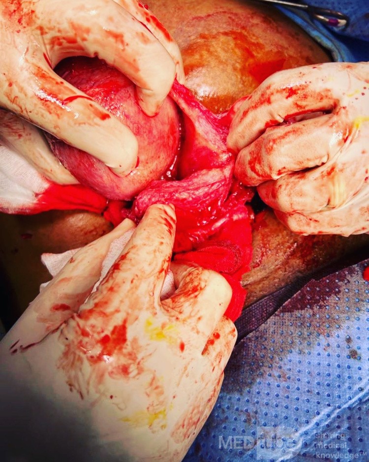Abdominal Myomectomy