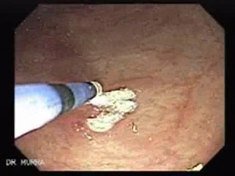 Multiple Gastric Angiodysplasia (16 of 17)
