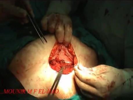 Cesarean Section - Closing Technique