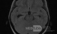 Endoscopic Third Ventriculostomy in a Benign Case of Aicardi Syndrome with Obstructive Hydrocephalus and Chiari Malformation type 1
