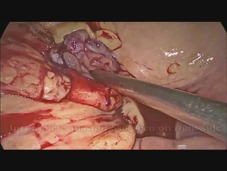 Revision of Colorectal Anastomosis in Laparoscopic Anterior Resection