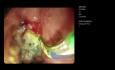 ERCP with Endoscopic Ampullectomy