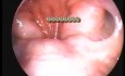 Soft Palate Elevation During The Phonation