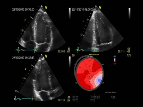 Calculation of Left Ventricle Ejection Fraction - Value of Global Area Strain.