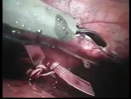 Laparoscopic Interventions In Pregnant (1/2)
